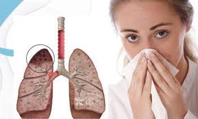 tuberculoza